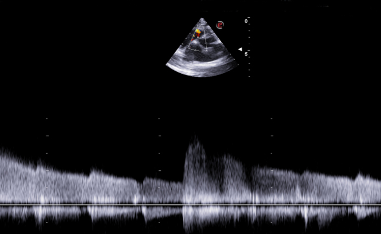 Systolic flow through the VSD, with left-to-right shunt, measured by continuous-wave Doppler