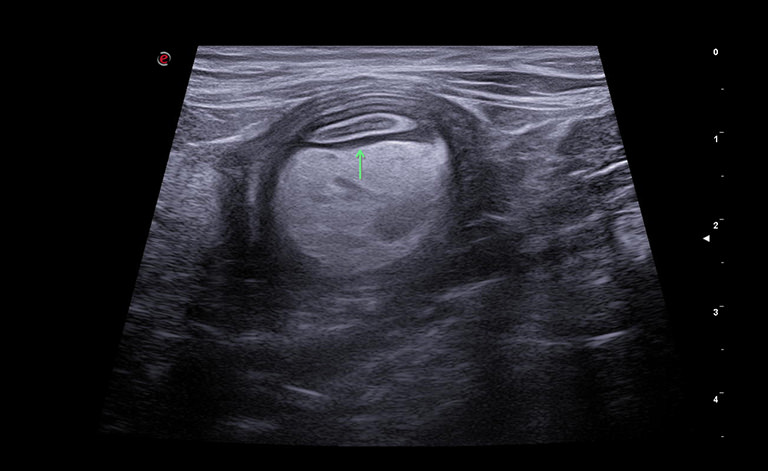 In this scan, the concentric structure is apparent, where the outer wall probably part of the colon...