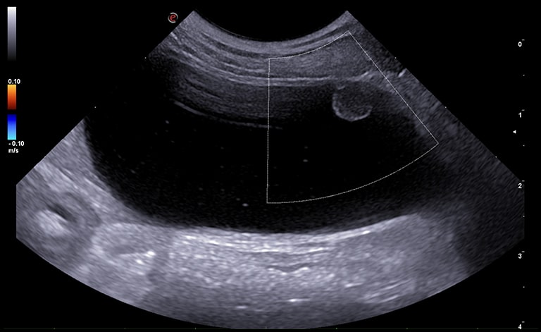 The bladder has punctiform hyperechoic contents in suspension