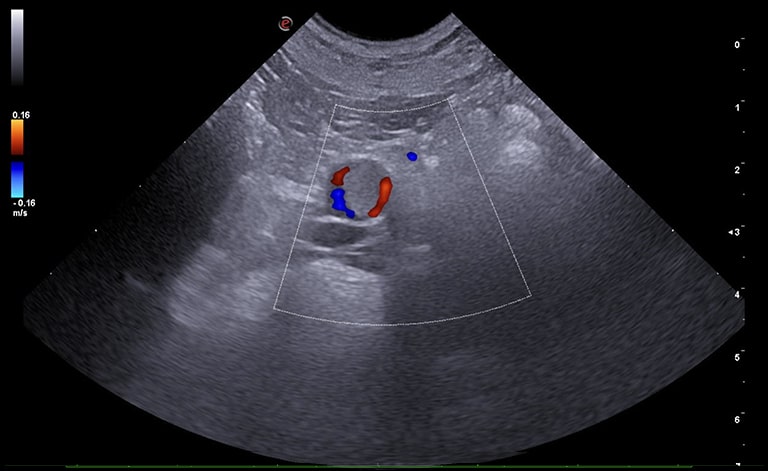 Aorta in transverse section