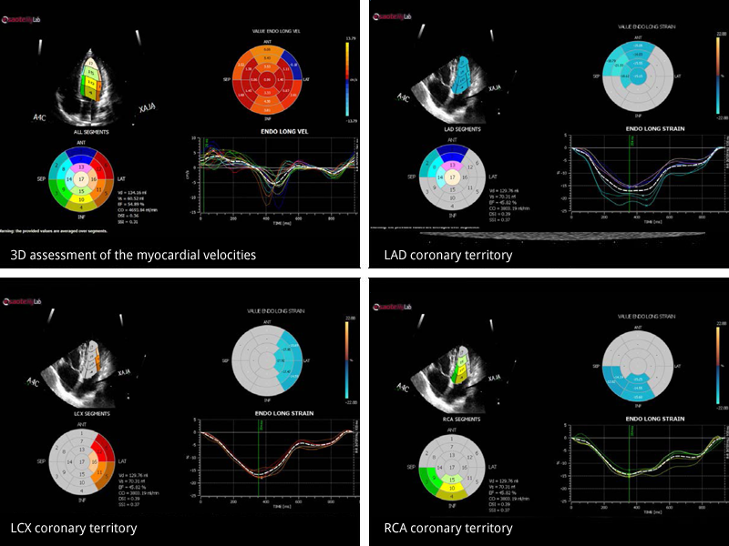 Myocardial deformation assessment by speckle tracking