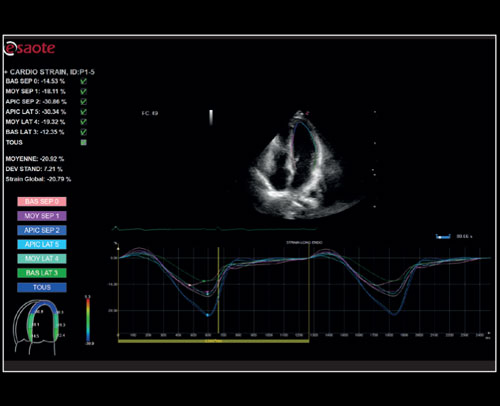 Cardiac - Zero-click strain evaluation with XStrain<sup>™</sup>2D