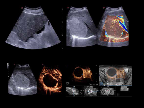 MyLab<sup>™</sup>X90 - Early detection to therapy for liver lesions