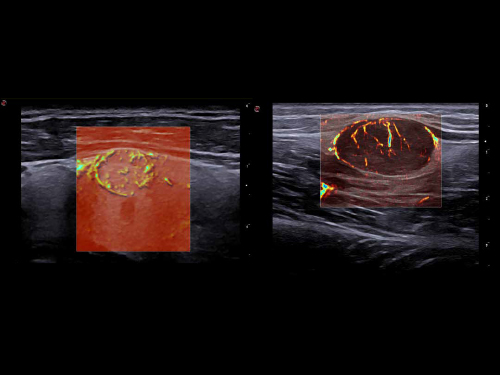 MyLab<sup>™</sup>X90 - No limits to the visualization of microvascularization