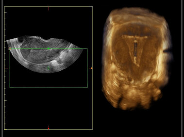 Clinical Image - MyLab<sup>™</sup>Omega - IUD visualization using 3D endocavitary probe