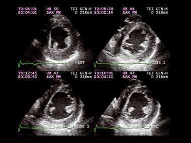 Imagen clínica - MyLab<sup>™</sup>Seven - Ecocardiografía de estrés