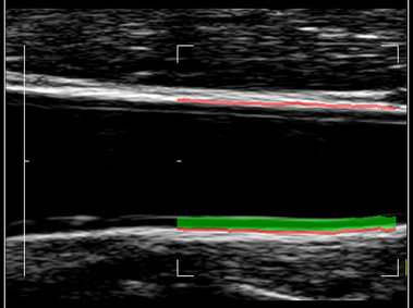 Clinical Image - MyLab<sup>™</sup>9 Platform - QIMT Intima-media thickness quantification based on radio frequencies in real-time studies