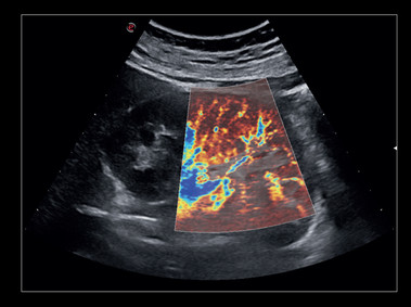 Clinical Image - MyLab<sup>™</sup>X8 Platform - Kidney - Tissue perfusion visualisation with microV