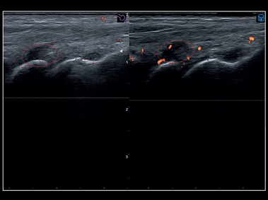 Clinical Image - MyLab<sup>™</sup>X8 Platform - Musculoskeletal - Evolution of the inflammation with Follow Up and Q-Pack