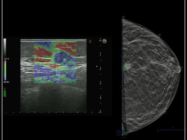 Clinical Image - MyLab<sup>™</sup>9 Platform - Breast BodyMap and real-time ElaXto in Mammo