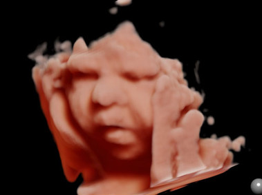 Clinical Image - MyLab<sup>™</sup>Twice - 4D Imaging - Obstetrics (XLight)