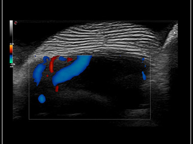 Clinical Image - MyLab<sup>™</sup>9 Platform - 24MHz Imaging even on fingerprint with CFM