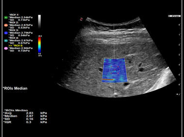 Clinical Image - MyLab<sup>™</sup>9 Platform - QElaXto 2D shearwave elastography in liver