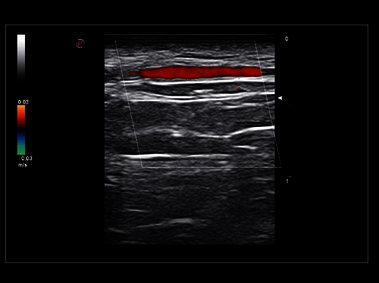 MyLab<sup>™</sup>Sigma Elite - Clinical Image - Temporal Artery exploration with Very High Frequency probe (22 MHz) (not available in all countries)