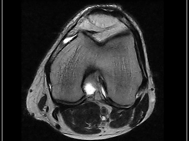 O-scan - Knee - FSE T2 Axial