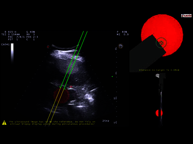Clinical Image - MyLab<sup>™</sup>Eight eXP - Lesion targeting in liver with Virtual Biopsy