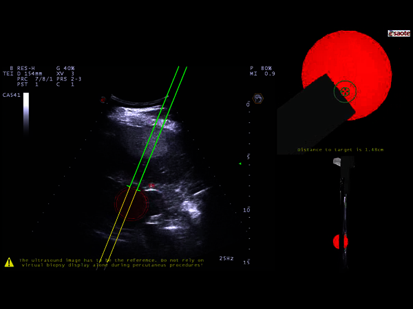 Clinical Image - MyLab™Eight eXP - Lesion targeting in liver with Virtual Biopsy