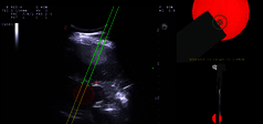 Clinical Image - MyLab™Eight eXP - Lesion targeting in liver with Virtual Biopsy