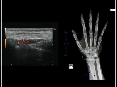 Clinical Image - MyLab<sup>™</sup>9 Platform - MSK BodyMap and real-time XFlow on X-Ray extremities