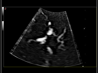 Clinical Image - MyLab<sup>™</sup>9 Platform - HD zoom transcranial vascularization analysis with microV