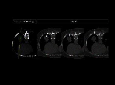 Clinical Image - MyLab<sup>™</sup>Eight eXP - Virtual Biopsy on Lungs; real positioning and perfect placement confirmed by CT scan