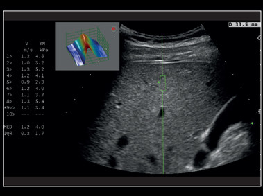 Clinical Image - MyLab<sup>™</sup>X8 Platform - Liver - Stiffness quantification with Q-ElaXto