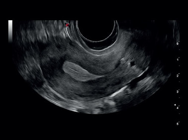 Clinical Image - MyLab<sup>™</sup>Gamma - Uterus (TEI&trade; - MView - XView Imaging)