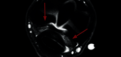 Immagine clinica - O-scan equine: Artropatia del nodello