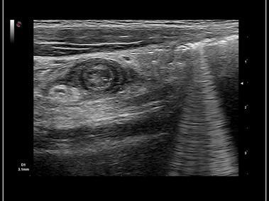 Clinical Image - MyLab<sup>™</sup>9 Platform - Axial view of appendicitis