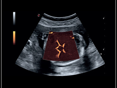 MyLab<sup>™</sup>Sigma - Clinical Image: Fetal Willis circle with Power Doppler