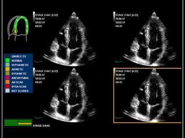 Clinical Image - MyLab<sup>™</sup>Omega - Stress Echo