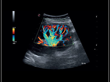 MyLab<sup>™</sup>Sigma - Clinical Image: Kidney perfusion with high sensitivity Color Doppler mode