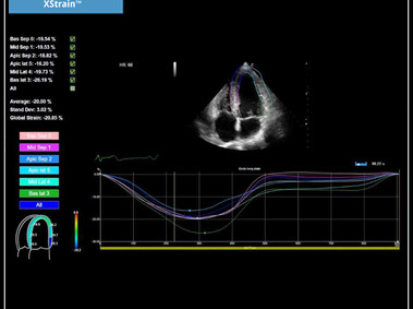 Clinical Image - MyLab<sup>™</sup>X7: XStrain<sup>™</sup>