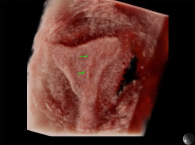 Clinical Image - MyLab<sup>™</sup>Twice - 3D Imaging - Gynaecology (XLight)