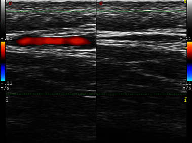Clinical Image - MyLab<sup>™</sup>Twice - Temporal arteritis - CFM with dual view