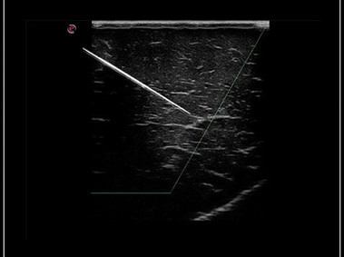 Clinical Image - MyLab<sup>™</sup>Omega - Optimal needle tip visualization using Needle Enhancement