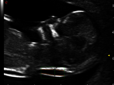 Clinical Image - MyLab<sup>™</sup>Omega - AutoNT