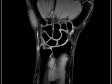 O-scan - Wrist - XBone Coronal