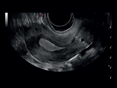 Klinisches Bild – MyLab<sup>™</sup>Gamma – Gebärmutter (TEI&amp;trade; – MView – XView-Bildgebung)