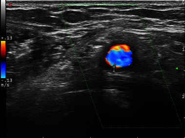 Clinical Image - MyLab<sup>™</sup>Twice - Axillary arteritis - CFM