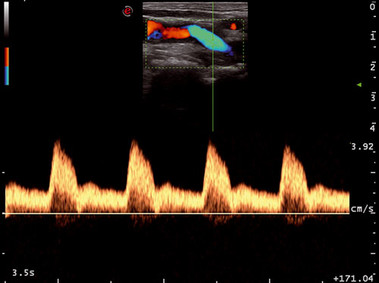 Клиническое изображение – MyLab<sup>™</sup>Seven – сонная артерия (PW Doppler)
