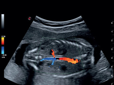 Imagen clínica - MyLab<sup>™</sup>Gamma - Doppler fetal en color (imagen CFM)