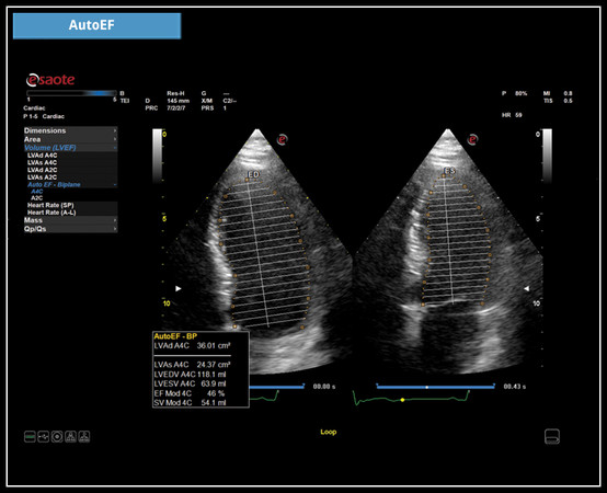 Клиническое изображение - MyLab™X5: технология AutoEF