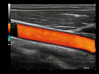 Клиническое изображение – MyLab<sup>™</sup>Alpha – сонная артерия (технология HD CFM)