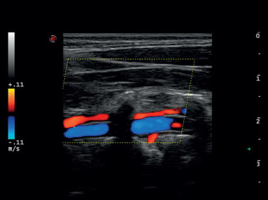 Klinisches Bild – MyLab<sup>™</sup>Gamma – Arteria und Vena vertebralis (B+CFM-Bildgebung)