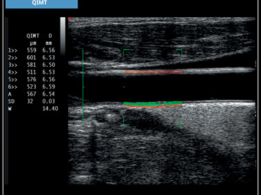 Clinical Image - MyLab<sup>™</sup>X7: QIMT