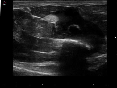 Clinical Image - MyLab<sup>™</sup>Gamma - Hand Flexor Pollicis Longus tendon