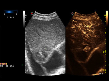 Clinical Image - MyLab<sup>™</sup>Twice - Contrast Enhanced Ultrasound
