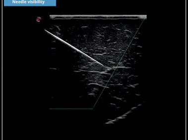 Clinical Image - MyLab<sup>™</sup>X5: Needle visibility