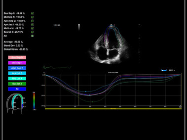 Clinical Image - MyLab<sup>™</sup>9 Platform - XStrain<sup>™</sup> 2D speckle tracking technologies for global and regional function